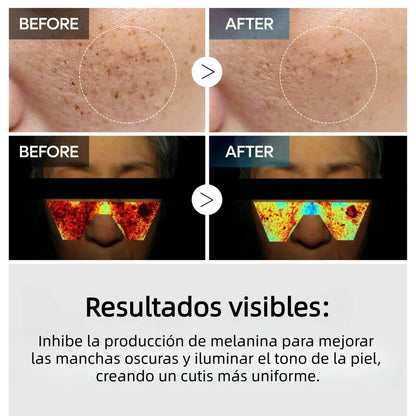 Crema de Ácido Tranexámico TX | Crema para Pecas en la Piel, Manchas, Anti-pigmentación