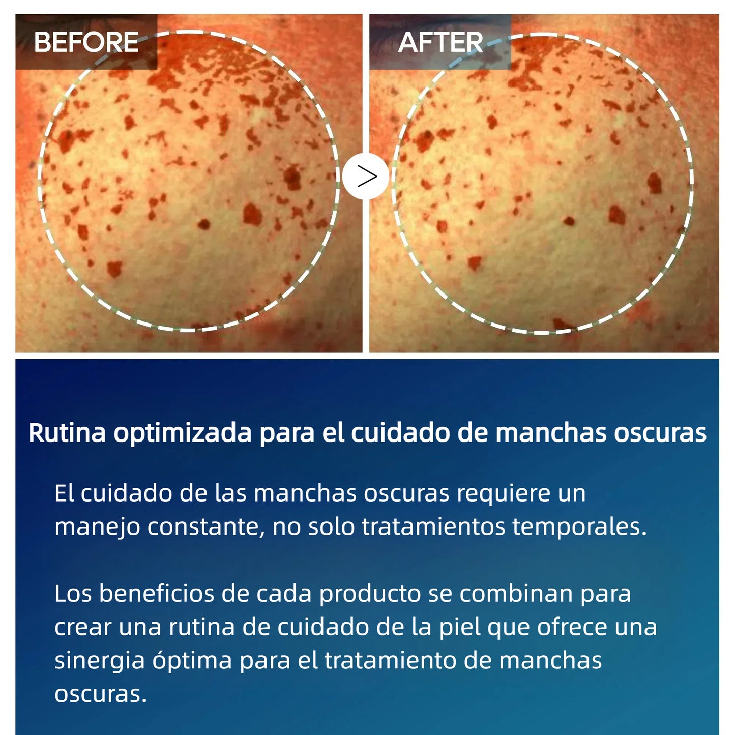 Crema de Ácido Tranexámico TX | Crema para Pecas en la Piel, Manchas, Anti-pigmentación