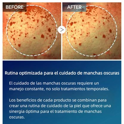 Crema de Ácido Tranexámico TX | Crema para Pecas en la Piel, Manchas, Anti-pigmentación